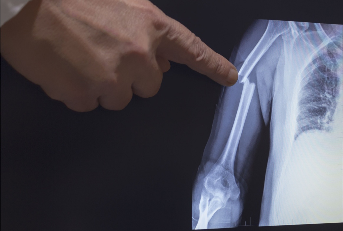 On the monitor screen is displayed an X-ray of a humerus fracture with the hand of a doctor pointing to the fracture