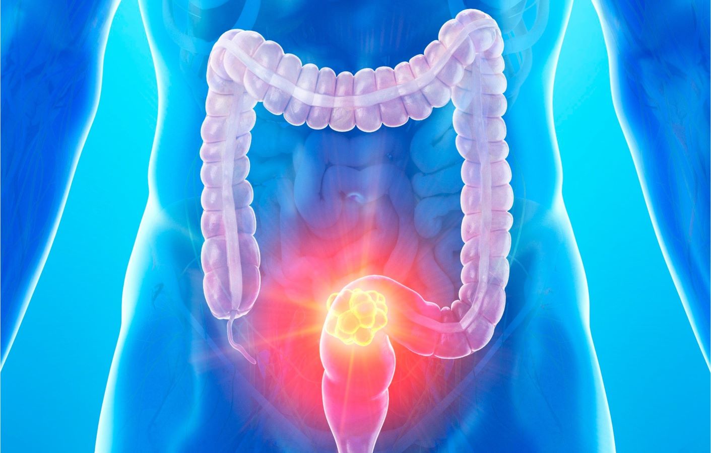 Colorectal Cancer 