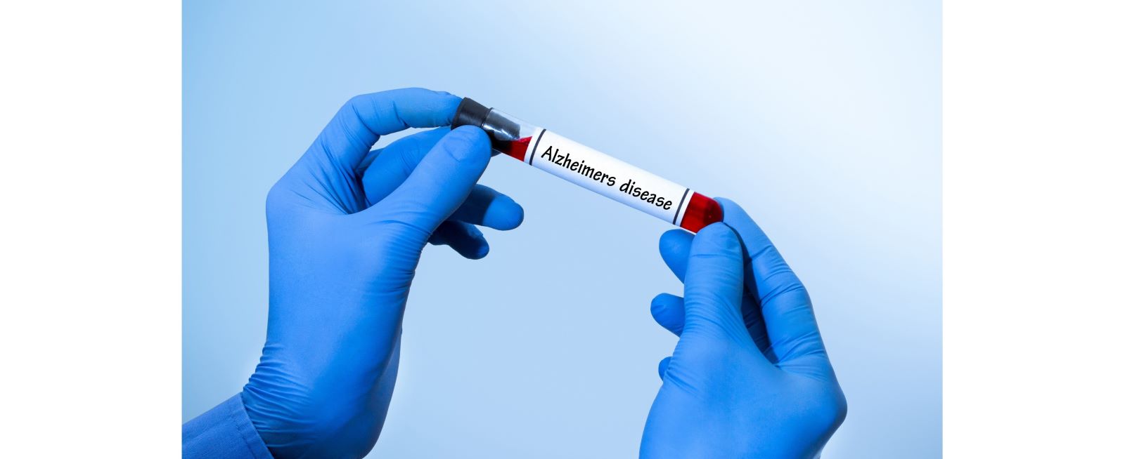 Holding test tube that says Alzheimer's test