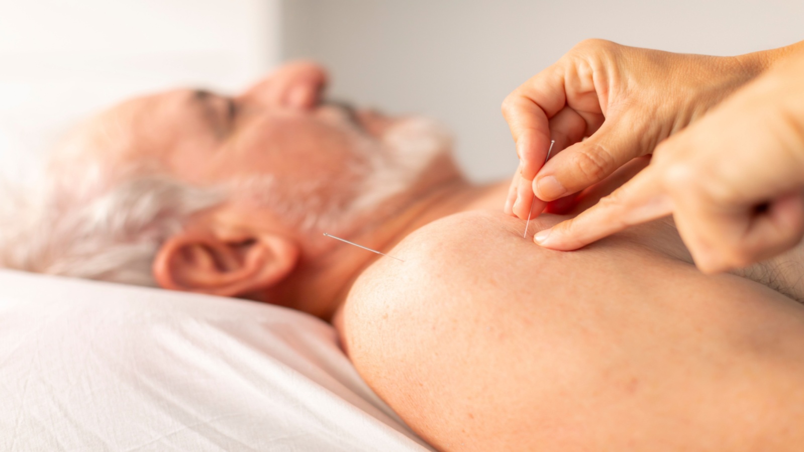 The hands of an acupuncturist places needles on the shoulder of an older man during an acupuncture session