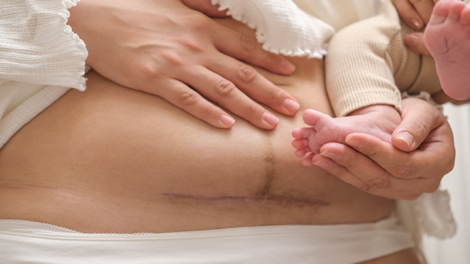 Close-up of C-section scar on lower abdomen, with mother holding newborn