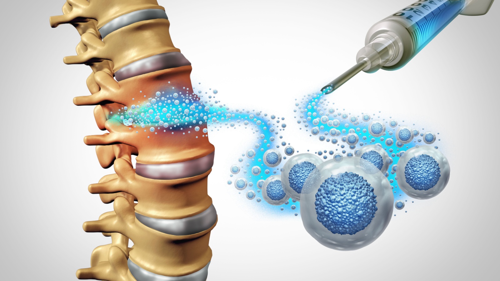 Mesenchymal cells injected for spinal joint pains to regenerate tissue repair as a medical cell therapy - 3D illustration