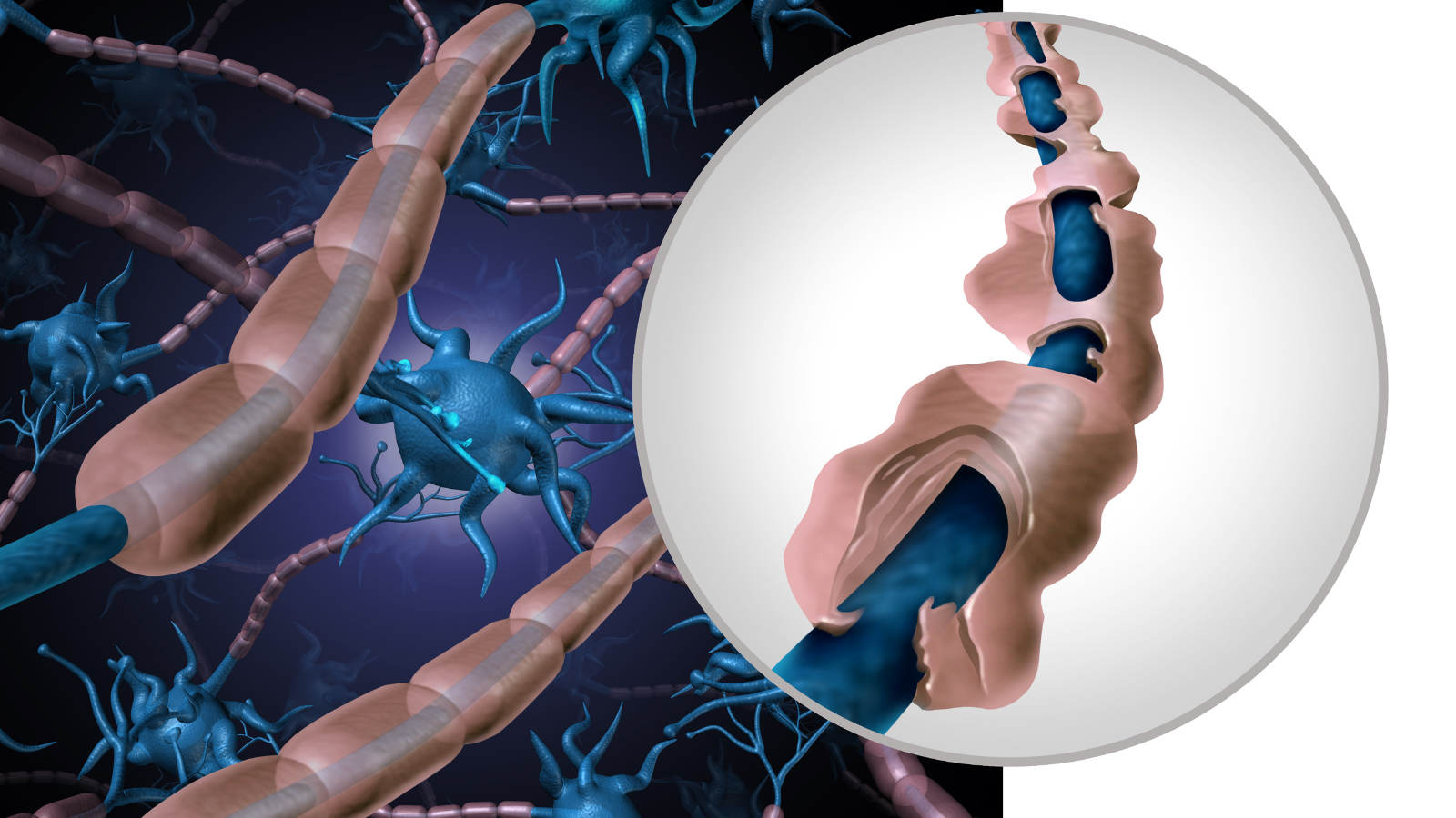 Myelin sheath degrading, which causes MS