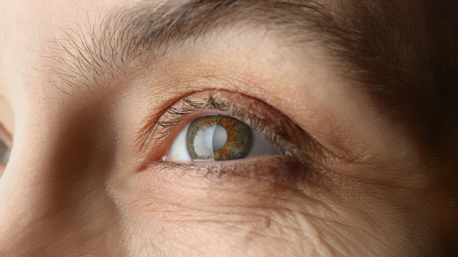 close up of person’s eye developing glaucoma