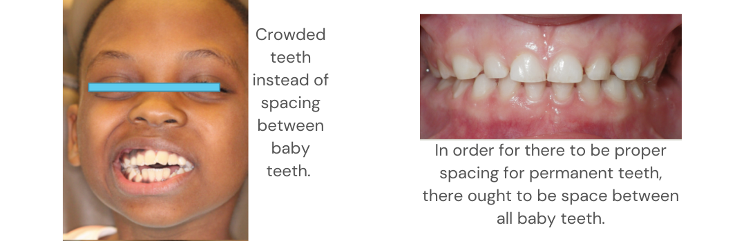 crowded teeth