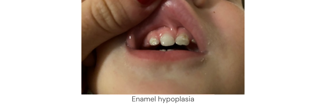 Enamel hypoplasia