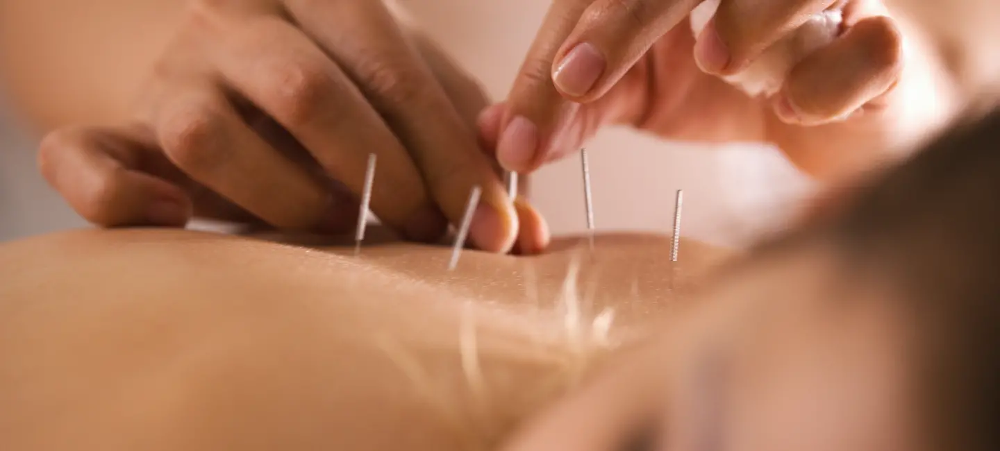 woman receiving Acupuncture