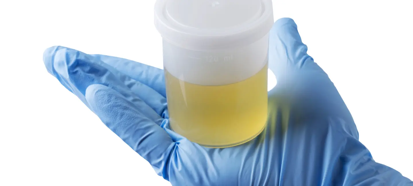 jar of urine tests in a hand