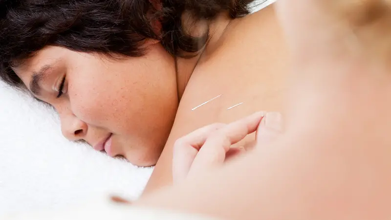 Shutterstock 89050780 boy getting acupuncture