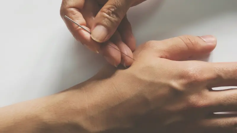 Acupuncture treatment on patient hand.
