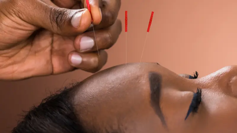 Woman Receiving Acupuncture Treatment 