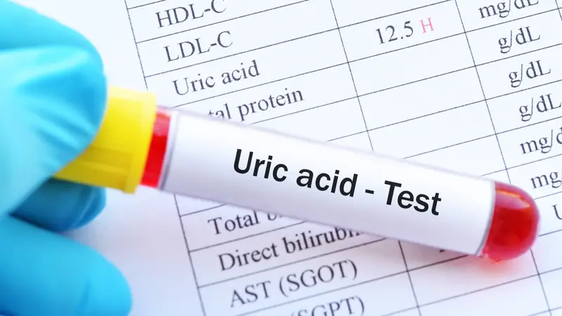 Blood sample tube with abnormal high uric acid test result