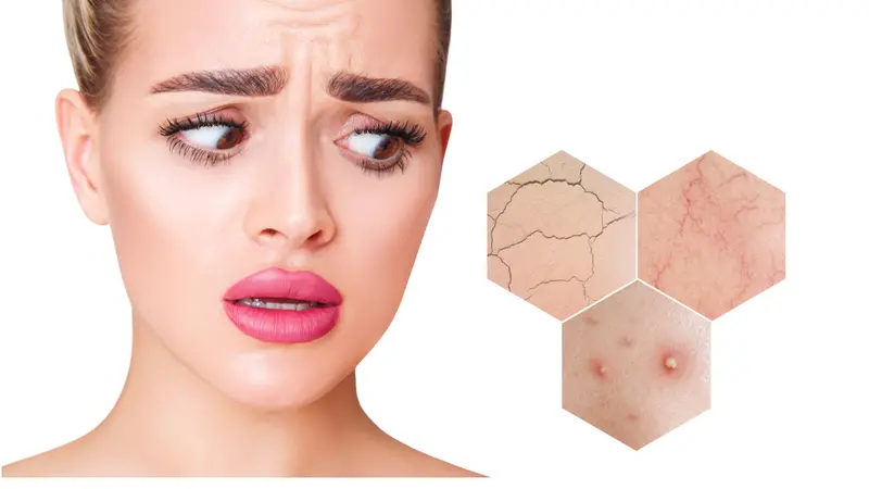 Woman with fear on face looks on hexagons with couperose and acne on face skin. Zoom hexagon shows skin problems. Woman with fear on face looks on hexagons with couperose and acne on face skin. Zoom hexagon shows skin problems.