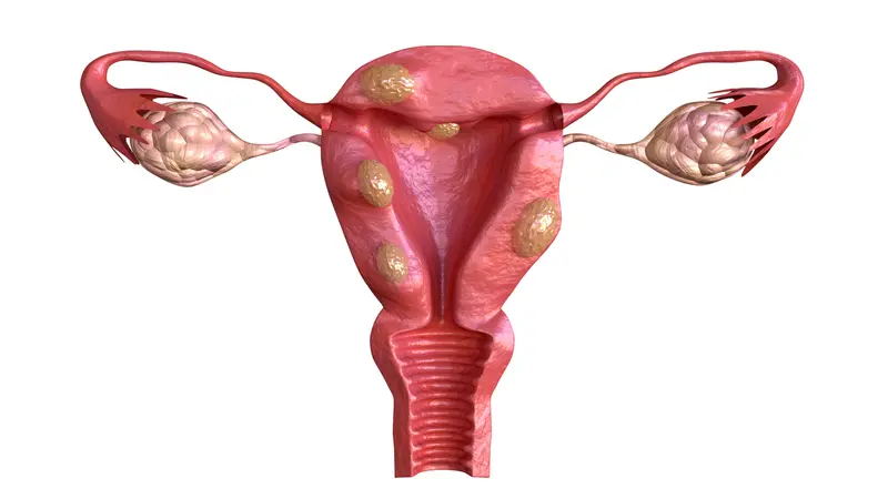 Uterine fibroid are benign solid tumors formed by muscle tissue.
