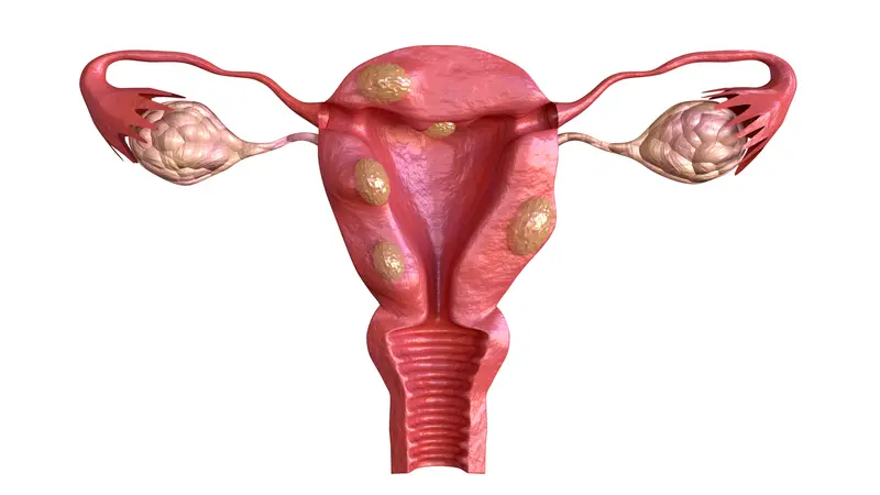 Uterine fibroid are benign solid tumors formed by muscle tissue. Uterine fibroid are benign solid tumors formed by muscle tissue.