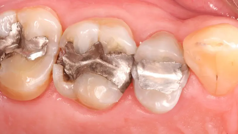 Dental amalgam dental restoration defective filling