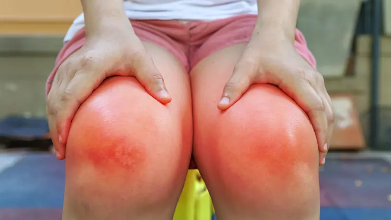 Rheumatoid arthritis, young woman suffering from pain in legs, knee swelling