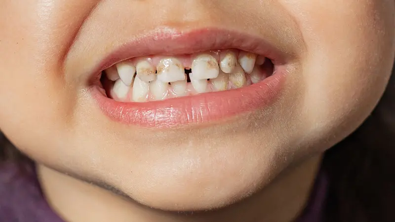 child shows teeth with hypoplasia child shows teeth with hypoplasia