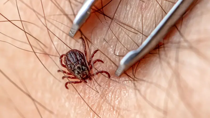 Removing of disease carrying tick from skin. Removing of disease carrying tick from skin.