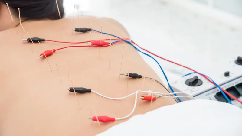 Asian woman receiving acupuncture with electrical stimulator at back