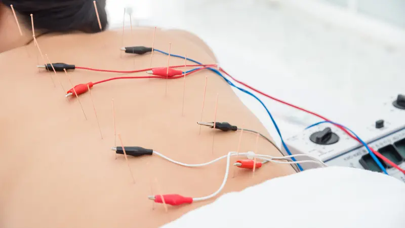Asian woman receiving acupuncture with electrical stimulator at back Asian woman receiving acupuncture with electrical stimulator at back
