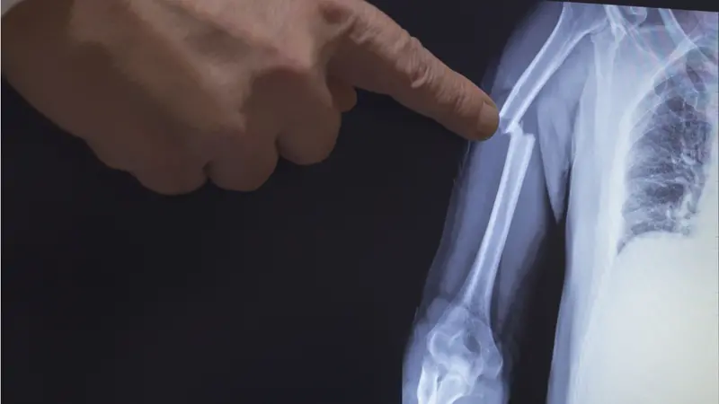 On the monitor screen is displayed an X-ray of a humerus fracture with the hand of a doctor pointing to the fracture On the monitor screen is displayed an X-ray of a humerus fracture with the hand of a doctor pointing to the fracture