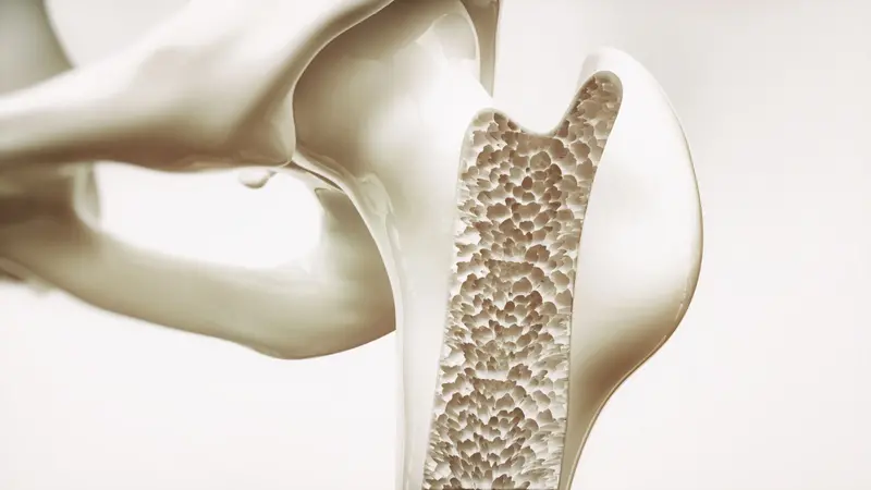 Osteoporosis stage 4 Osteoporosis stage 4