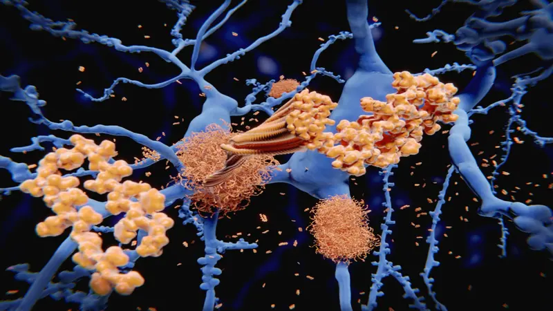 Alzheimer's disease: the amyloid-beta peptide accumulates to amyloid fibrils that build up dense amyloid plaques. 3d rendering Alzheimer's disease: the amyloid-beta peptide accumulates to amyloid fibrils that build up dense amyloid plaques. 3d rendering