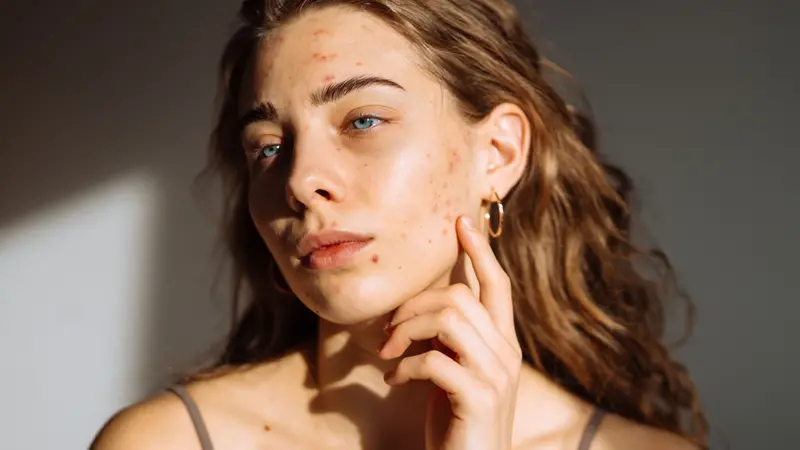 Woman with acne Woman with acne