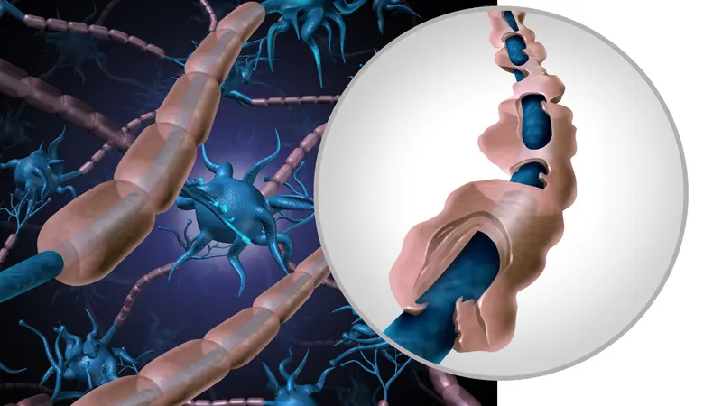 Myelin sheath degrading, which causes MS