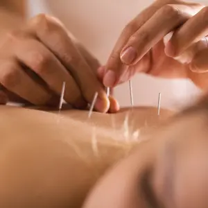 woman receiving Acupuncture