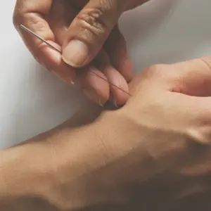 Acupuncture treatment on patient hand.
