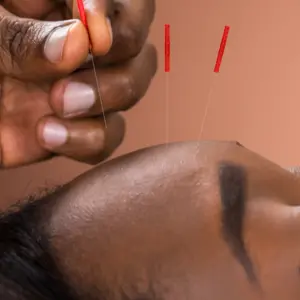 Woman Receiving Acupuncture Treatment 