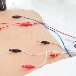 Woman receiving acupuncture with electrical stimulator at back