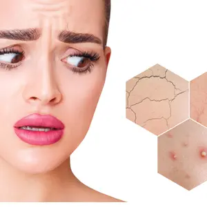 Woman with fear on face looks on hexagons with couperose and acne on face skin. Zoom hexagon shows skin problems.