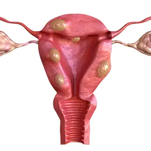 Uterine fibroid are benign solid tumors formed by muscle tissue.