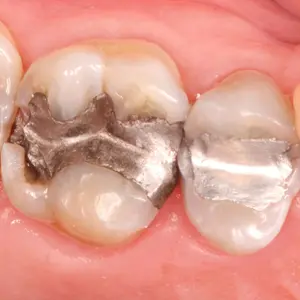 Dental amalgam dental restoration defective filling