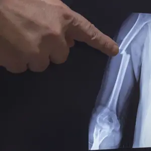 On the monitor screen is displayed an X-ray of a humerus fracture with the hand of a doctor pointing to the fracture On the monitor screen is displayed an X-ray of a humerus fracture with the hand of a doctor pointing to the fracture