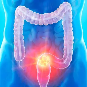 Colorectal Cancer Colorectal Cancer
