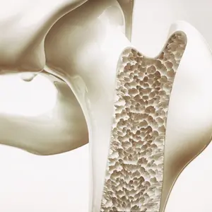 Osteoporosis stage 4 Osteoporosis stage 4