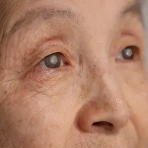 close-up of an elderly woman with cataracts